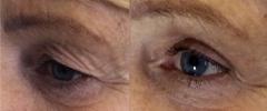 NonSurgical Eyelid Lift, Crows Feet, Crepey Skin, Turkey Neck tightening
